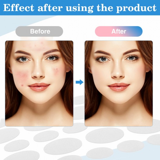 108Pcs Acne Pimple Patches Spot Repair Hydrocolloid Mole Removal Face Sticker