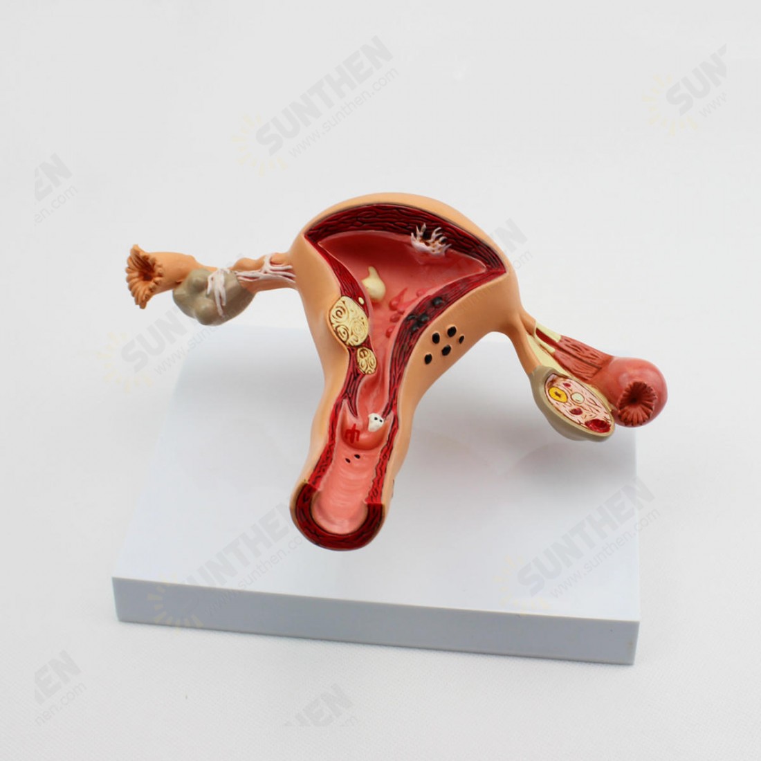 1Pcs Uterus Ovary Anatomical Medical Model Anatomy Cross-Section ...